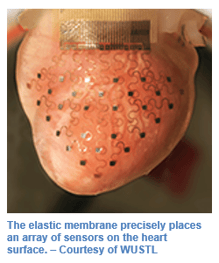 heart-implant-kapstone-medical-2